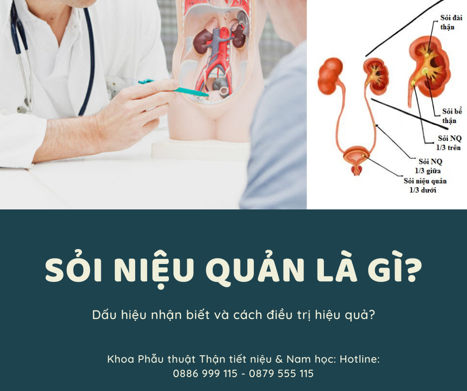 Sỏi niệu quản là gì