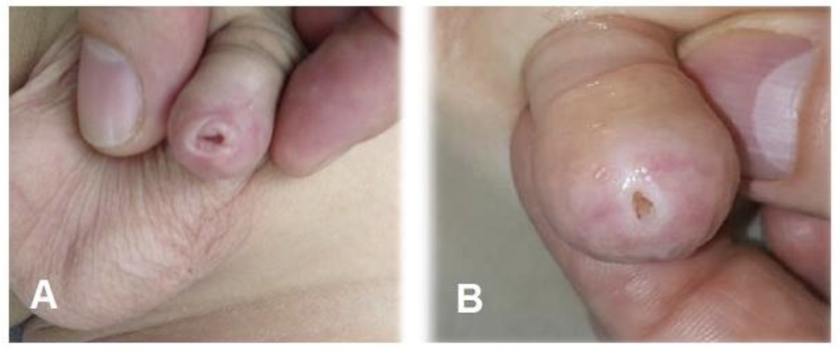 Hình 3: Hình ảnh xơ hẹp bao quy đầu