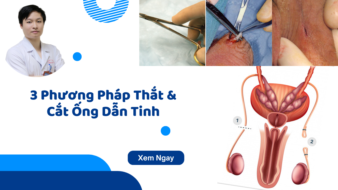 3 Phương pháp thắt ống dẫn tinh