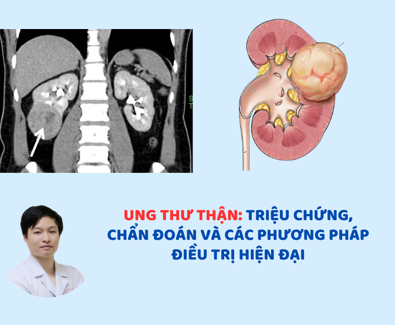 Ung thư thận, triệu chứng, chẩn đoán và các phương pháp điều trị hiện đại