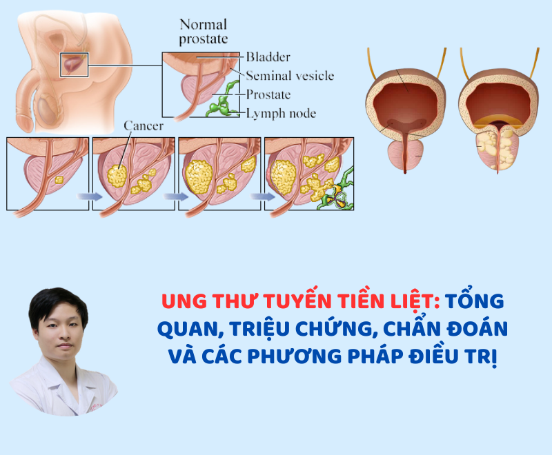 Ung thư tuyến tiền liệt: Tổng quan, triệu chứng, chẩn đoán và các phương pháp điều trị