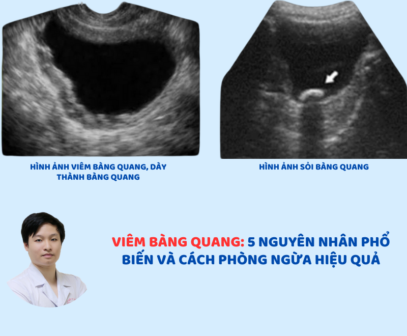 Viêm bàng quang: 5 nguyên nhân phổ biến và cách phòng ngừa hiệu quả