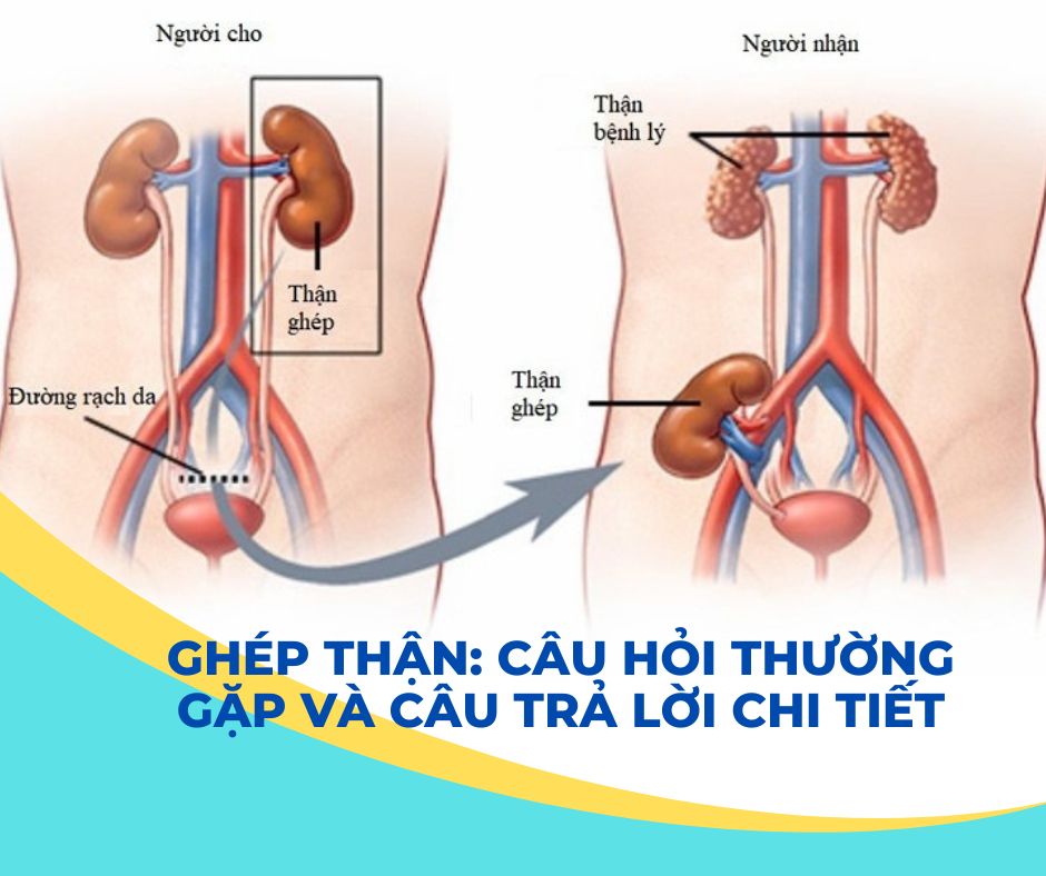 Ghép thận: Câu hỏi thường gặp và câu trả lời chi tiết
