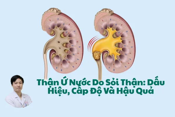 Thận Ứ Nước Do Sỏi Thận: Dấu Hiệu, Cấp Độ Và Hậu Quả