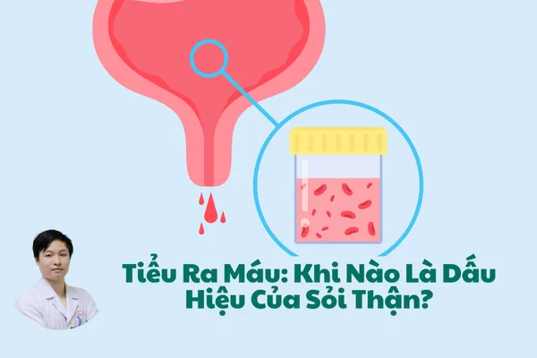 Tiểu Ra Máu- Khi Nào Là Dấu Hiệu Của Sỏi Thận?